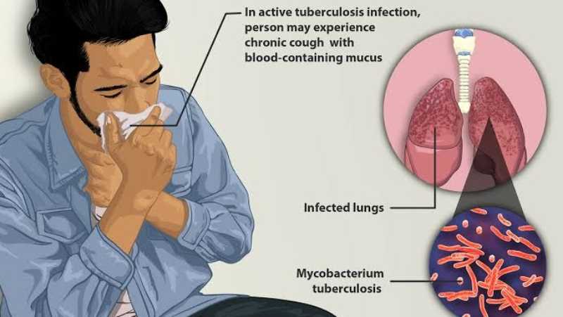 Natural Remedies for Tuberculosis